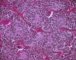 Immature paraganglioma of the vesical region