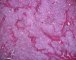 Immature paraganglioma of the vesical region