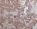 Synaptophysin staining in immature paraganglioma of the vesical (...)