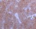 Synaptophysin staining in immature paraganglioma of the vesical (...)