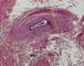 Glandular inclusion in inguinal hernia sacs