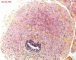 Glandular inclusion in inguinal hernia sacs
