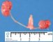 Unilateral renal ectopia (simple ectopia) and renal hypoplasia (Fetus 20 (...)