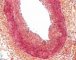 Intimal fibrosis in pulmonary artery