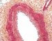 Intimal fibrosis in pulmonary artery