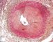 Intimal fibrosis in pulmonary artery