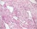 Primitive myxoid mesenchymal tumor of infancy (PMMTI) (Case (...)