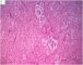 Mediastinal intermixed ganglioneuroblastoma