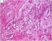 Mediastinal intermixed ganglioneuroblastoma