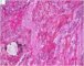 Mediastinal intermixed ganglioneuroblastoma