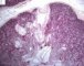 Fetal oligocystic kidneys of unknow cause (case 11389)