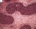 Blastemal component in Wilms tumor