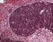 Blastemal component in Wilms tumor