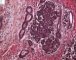 Blastemal component in Wilms tumor