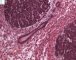 Blastemal component in Wilms tumor