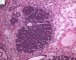Blastemal component in Wilms tumor