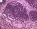 Blastemal component in Wilms tumor