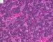 Mediastinal poorly differentiated neuroblastoma (Case 11541)