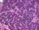 Mediastinal poorly differentiated neuroblastoma (Case 11541)