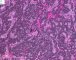 Mediastinal poorly differentiated neuroblastoma (Case 11541)