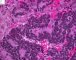 Mediastinal poorly differentiated neuroblastoma (Case 11541)