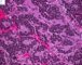 Mediastinal poorly differentiated neuroblastoma (Case 11541)