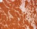 NSE immunostaining of a poorly differentiated neuroblastoma (Case (...)