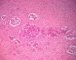 Pelvic intermixed ganglioneuroblastoma (Case 11543)