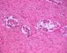 Pelvic intermixed ganglioneuroblastoma (Case 11543)
