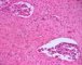 Pelvic intermixed ganglioneuroblastoma (Case 11543)