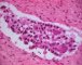 Pelvic intermixed ganglioneuroblastoma (Case 11543)