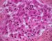 Pelvic intermixed ganglioneuroblastoma (Case 11543)