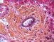 Adenoviral inclusion in adenoviral cholangitis (Case 11613)