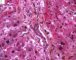 Adenoviral inclusion in adenoviral cholangitis (Case 11613)