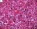 Adenoviral inclusion in adenoviral cholangitis (Case 11613)