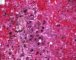 Adenoviral inclusion in adenoviral cholangitis (Case 11613)
