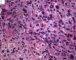 Case 11734: Femoral osteoblastic osteosarcoma