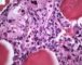 Case 11734: Femoral osteoblastic osteosarcoma