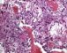 Case 11734: Femoral osteoblastic osteosarcoma