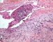 Case 11734: Femoral osteoblastic osteosarcoma