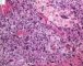 Case 11734: Femoral osteoblastic osteosarcoma