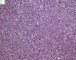 Monophasic synovial sarcoma (Case 11736)