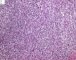 Monophasic synovial sarcoma (Case 11736)