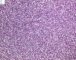 Monophasic synovial sarcoma (Case 11736)
