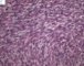 Monophasic synovial sarcoma (Case 11736)