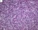 Monophasic synovial sarcoma (Case 11736)