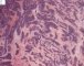 Desmoplastic small round cell tumor (DSRCT)