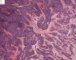 Desmoplastic small round cell tumor (DSRCT)