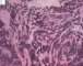 Desmoplastic small round cell tumor (DSRCT)