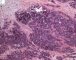 Desmoplastic small round cell tumor (DSRCT)
